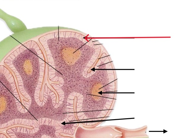 <p>Which part of lymph node:</p><ul><li><p>Just beneath capsule</p></li></ul><p></p>