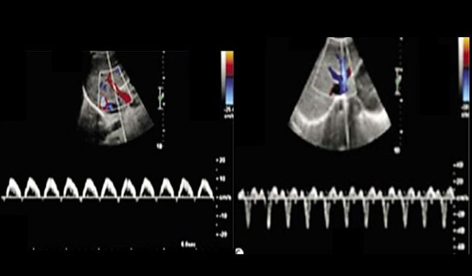 <p>what is a potential cause for these doppler findings?</p>