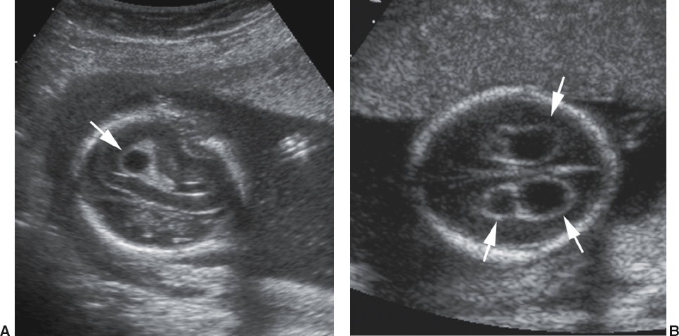 <p>Anechoic, round, smooth-walled cyst located within the choroid plexus of the lateral ventricle</p>