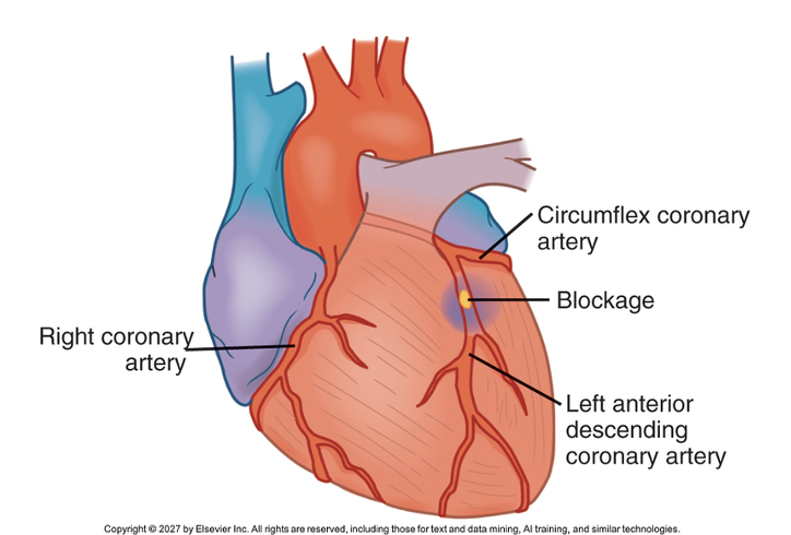 <p><span>•<strong>Left Coronary Artery branches:</strong></span></p><p><span>•Supply blood to the left atrium, left ventricle, interventricular septum, part of right ventricle</span></p><p><span>•Left anterior descending artery (LAD)</span></p><p><span>•Left circumflex artery (LCA)</span></p><p><span>•“Widowmaker”</span></p><p><span>•High rate of mortality!</span></p><p><span>•<strong>Right Coronary Artery (RCA)</strong></span></p><p><span>•Supplies blood the right atrium, right ventricle, part of posterior wall of the left ventricle</span></p><p><span>•Severe cardiac conduction effects if obstruction occurs here</span></p><p><span>•<strong>Nitroglycerin contraindicated</strong></span></p>