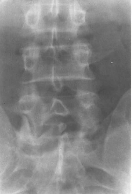 <p>Asymmetric articular planes; MC at L5/S1 </p>