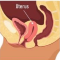 <p>Uterus descends toward or into the vagina </p><p>-Presentation: bulge or pressure symptoms, stress urinary incontinence, constipation, low back pain, pelvic pain, sexual dysfunction</p><p>-Dx: pelvic exam, increase in defect with valsalva </p><p>-Tx: vaginal pessary, pelvic floor exercises, surgical treatment </p>