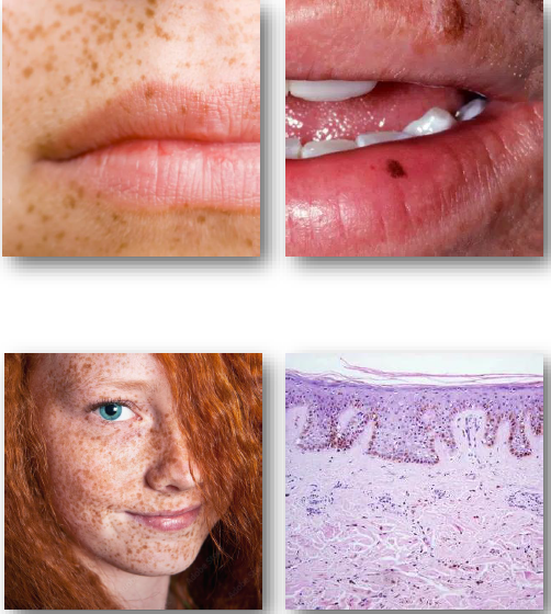 <p>• No treatment required for typical lesions</p><p>• Sun protection reduces darkening</p><p>• Reassure patient of benign nature</p><p>• Refer if lesion appears atypical</p><p>• No risk of malignant transformation</p>