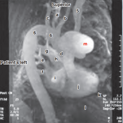 <p>Please label the aneurism in the aortic arch </p>