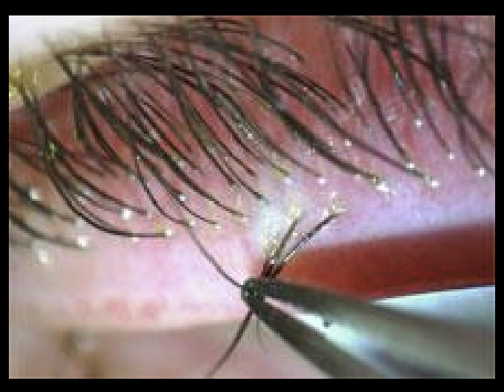 <ul><li><p>Chronic, recurrent blepharitis</p></li><li><p>Poor response to standard lid hygiene</p></li><li><p>Often associated with cylindrical dandruff at lash base</p></li></ul><p></p>