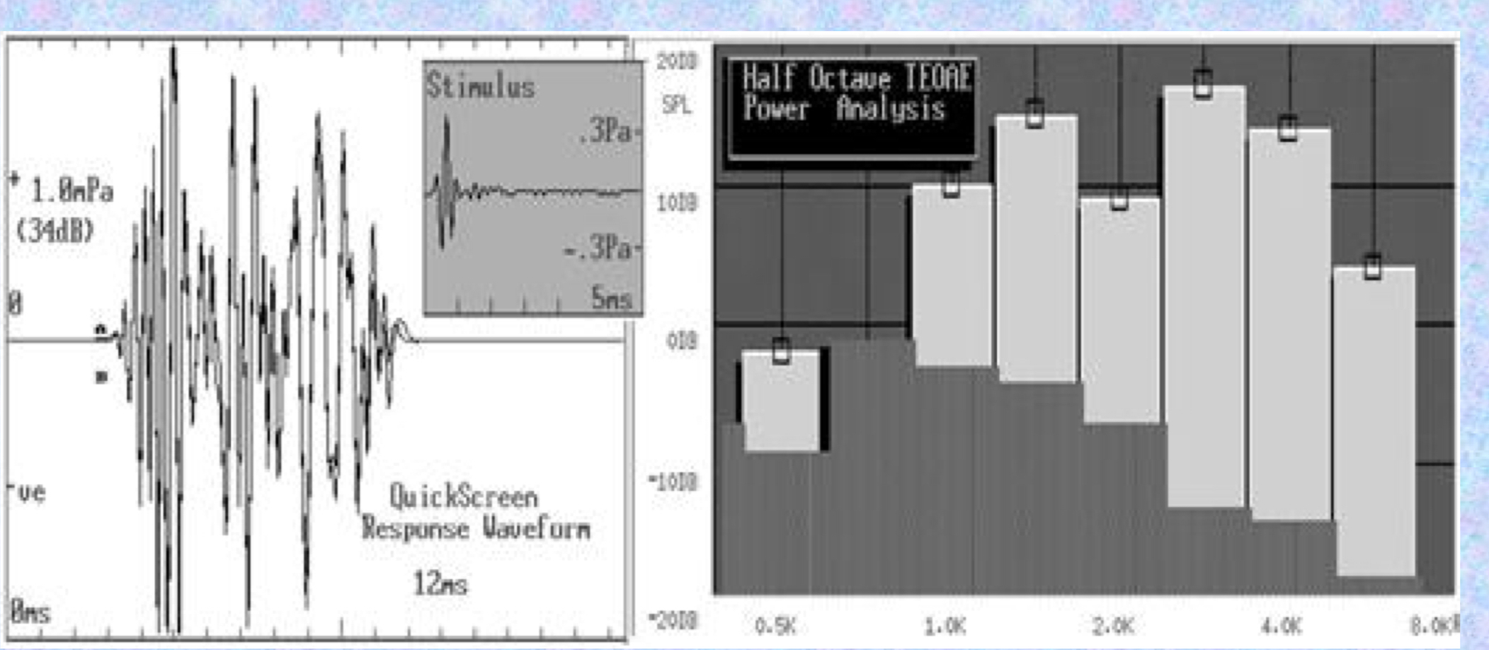 <p>TRANSIENT OAE</p>