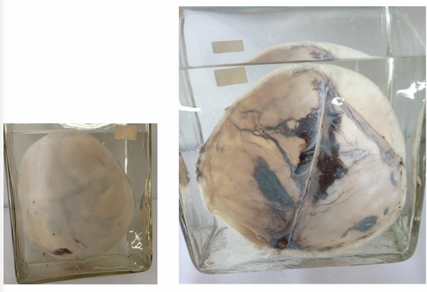 <p>Questions</p><ol><li><p>What is the specimen being examined?</p></li><li><p>What are the four specific pathological and traumatic findings shown on the skull?</p></li><li><p>How is the antemortem nature of the injury determined?</p></li><li><p>What type of causative instrument is indicated by these collective findings?</p></li><li><p>How is the time of death estimated?</p></li><li><p>What are the possible causes of death?</p></li><li><p>What is the final diagnosis for this specimen?</p></li></ol><div data-type="horizontalRule"><hr></div><p></p>