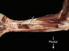 <p>In this anterior view of a partially dissected right forearm, identify the muscle indicated by the arrow.</p>