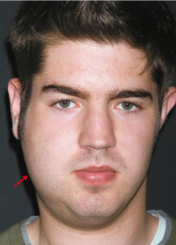 <p>Pathogen → Mumps virus, Paramyxoviridae</p><p>Symptoms → Painful swelling of parotoid glands</p><p>Incubation period → 16-18 days</p><p>Diagnostic Test → Symptoms; virus culture</p><p>Prevention → Attenuated vaccine (MMR vaccine)</p><p>*Transmitted in the saliva and respiratory secretions</p><p>*May cause orchitis (swelling of testes), meningitis, ovary inflammation, and pancreatitis</p>