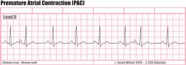<p>sinus rhythm with a PAC</p>