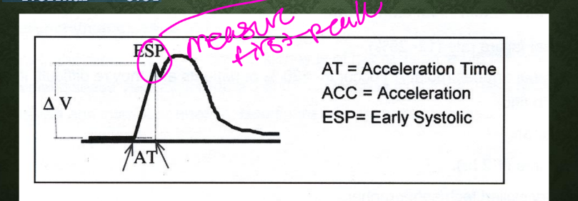 <p>INDIRECT METHOD</p><p>INTERPRETATION</p><p>• Acceleration time (AT)</p><p>• Time interval from the onset of systole to the initial peak systolic</p><p>velocity</p><p>• Calipers must be placed at the base of the systolic upstroke and</p><p>at peak systole</p><p>• Normal – <0.07</p>