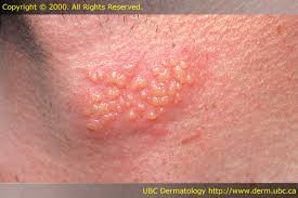 <p>elevated cavity holding fluid, up to 1 cm (blisters, herpes)</p>