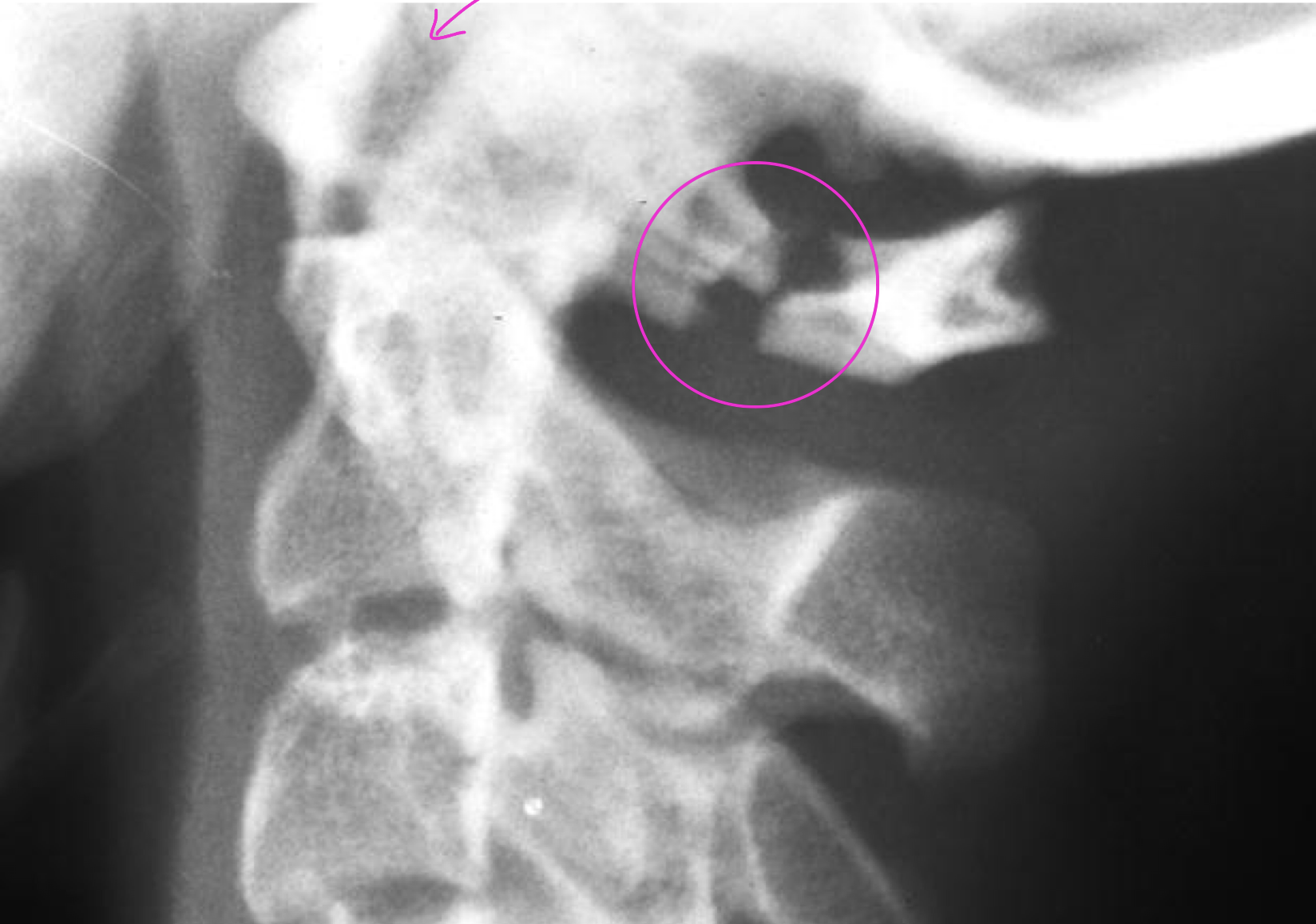 <p>Can we say that this posterior arch fx is stable</p>
