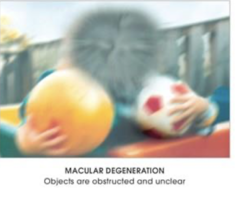 <p>-Damage to the macula </p><p>-Macula contains lots of cones which means it is receiving a lot of details</p><p>-Central vision affected</p>