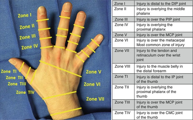 <p><span style="color: red;"><strong>Zone I/1</strong></span> Extensor Injury <strong>“Mallet Finger” </strong></p>