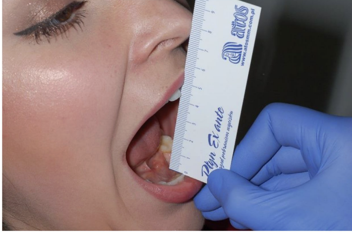 <p>• Measuring how far the jaw can open, both comfortably and with maximum effort. Measure between top &amp; bottom teeth. Observing the movement for any deviations or pain. </p><p>• Normal opening range is typically between 40-55 mm. Greater than 50mm is considered “hyper-mobile” </p><p>• “3-finger test”</p>