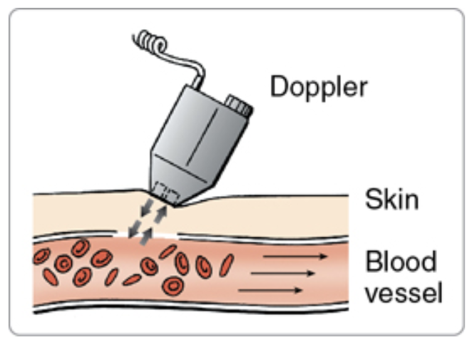 <p>Doppler ultrasound</p>