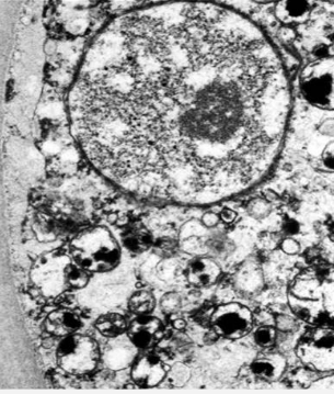 <ul><li><p>branduolio chromatinas tirpsta</p></li><li><p>susdiaro blyškios ertmės</p></li></ul><p></p>