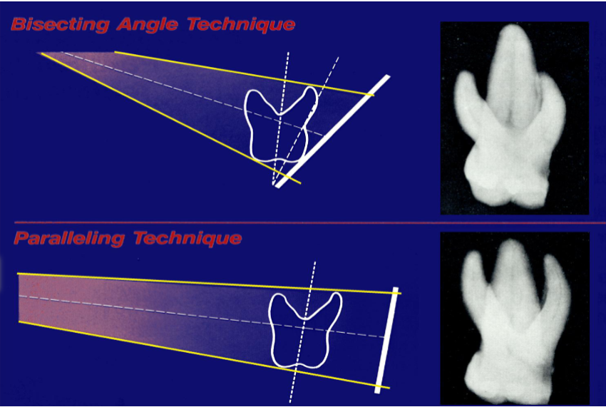 <ul><li><p>Bisecting Angel: </p><ul><li><p>put film as close to teeth as possible</p></li><li><p>perpendicularly angle cenral ray bisects the angle between the teeth and the film/sensor.</p></li></ul></li><li><p>Paralleling Technique</p><ul><li><p>place film paraelle to long axis of tooth</p><ul><li><p>will lesses distortion</p></li><li><p>usual method</p></li></ul></li></ul></li></ul><p></p>