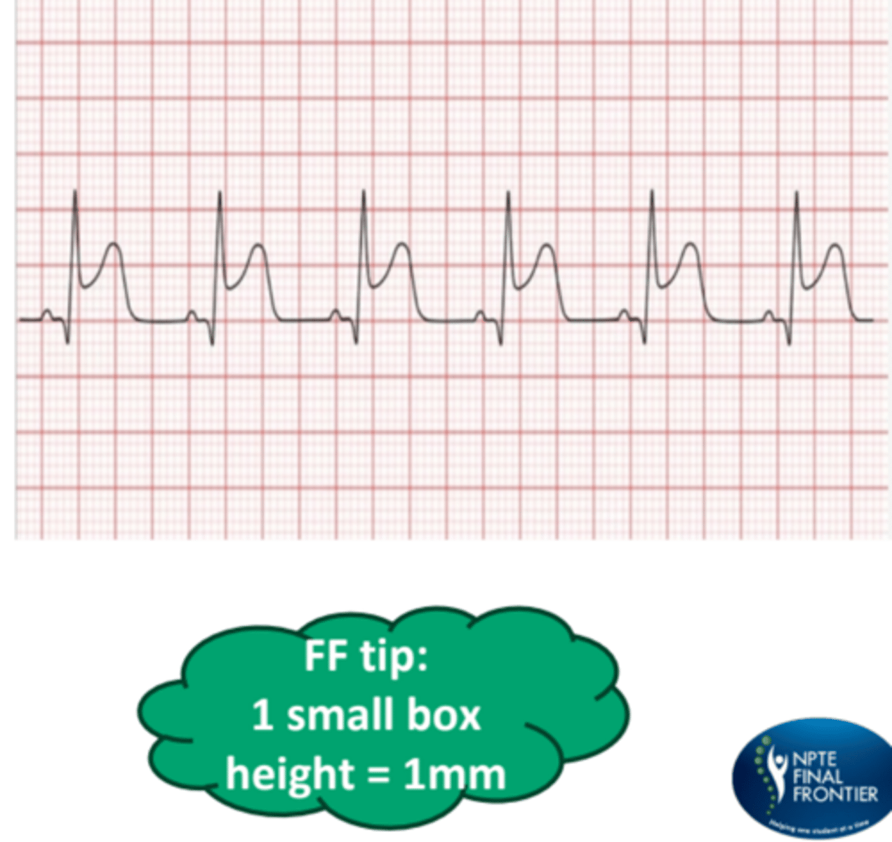 <p>Myocardial infarction that has an elevation of the ST segment greater than 1 mm and the PT should stop the protocol and call 911</p>
