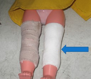 <p><span>for patellar affection</span></p>