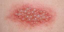 <p>Elevación superficial con líquido claro, ≤1 cm</p>