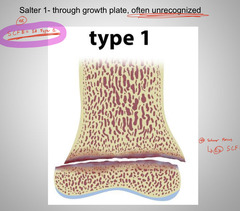 <p>SCFE</p>