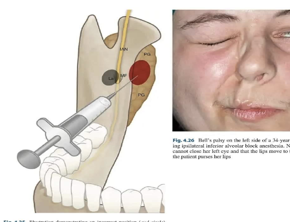 <p><strong>Complication</strong> – After administering an IANB, the pt's face on the side that was injected "droops" and the pt is unable to close their eyelid</p>