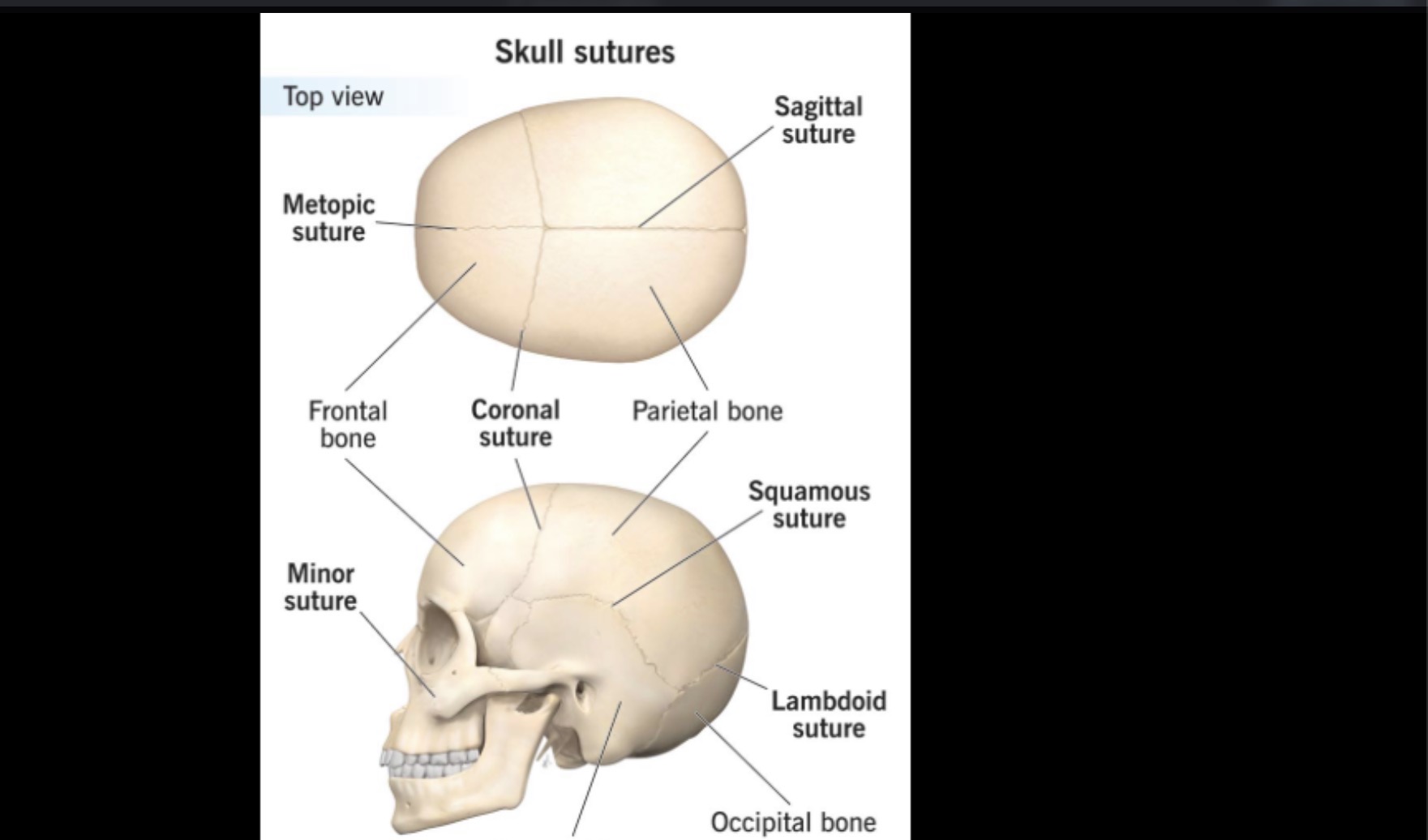 <p><mark>the dense, fibrous joint connecting the frontal bone (forehead) to the two parietal bones (top of the skull)</mark></p>