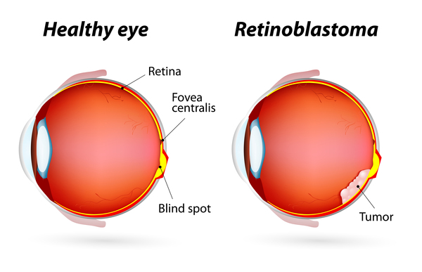 <ul><li><p>primitive neuroectodermal tumor (PNET) that develops in the retina</p></li><li><p>recessive genetic defect; both alleles of the RBI gene must be mutated</p></li></ul><p></p>