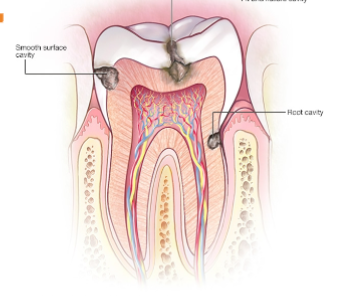 <p>Gingivitis</p>