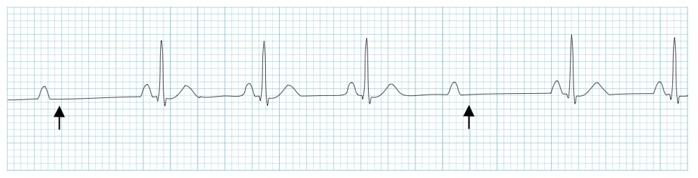 <p>What does this EKG show?</p>