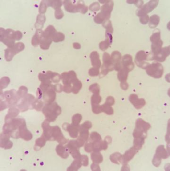 <p>Name: <span><span>Plasmodium Falciparum </span></span></p><p><span><span>Stage: Gametocyte</span></span></p>