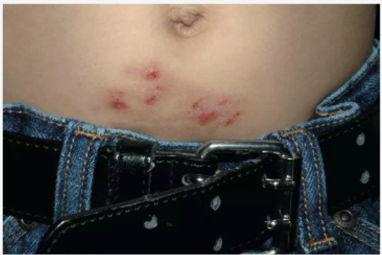 <p>Dermatosis que afecta región infraumbilical con eritema, erosiones y costras muy pruriginoso. Según la imagen presentada cuál es su diagnóstico?</p>