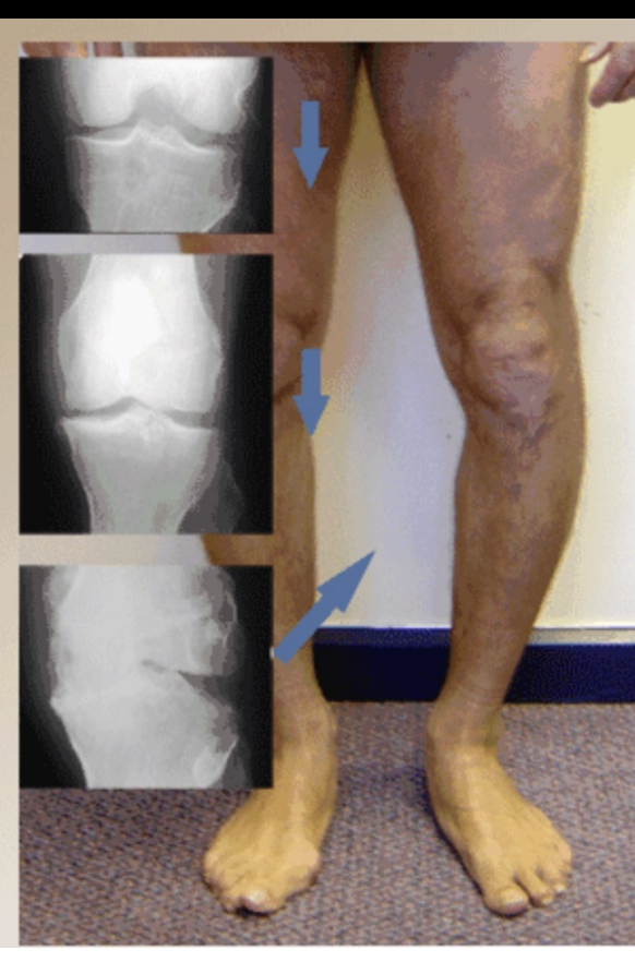 <p>The Evidence- What we know: </p><ul><li><p>obesity affects outcome </p></li><li><p>interferential current for pain relief </p></li><li><p>manual therapy plus exercise better than home program </p></li><li><p>alignment affects pain and disability </p></li><li><p>psychosocial - self efficacy improves function </p></li><li><p>adherence - improves long term outcomes </p></li></ul><p></p>