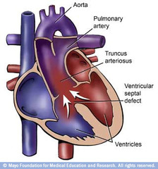 <p>-truncus never completely separates into the aorta and pulmonary arteries--->one great vessel with a single valve</p>