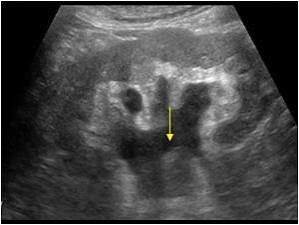 <ul><li><p>hypo mass in collecting system</p></li><li><p> low vascularity </p></li><li><p>may invade adjacent renal parenchyma </p></li></ul><p></p>