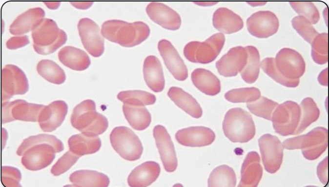 <p>What abnormal RBC shape is shown?</p>