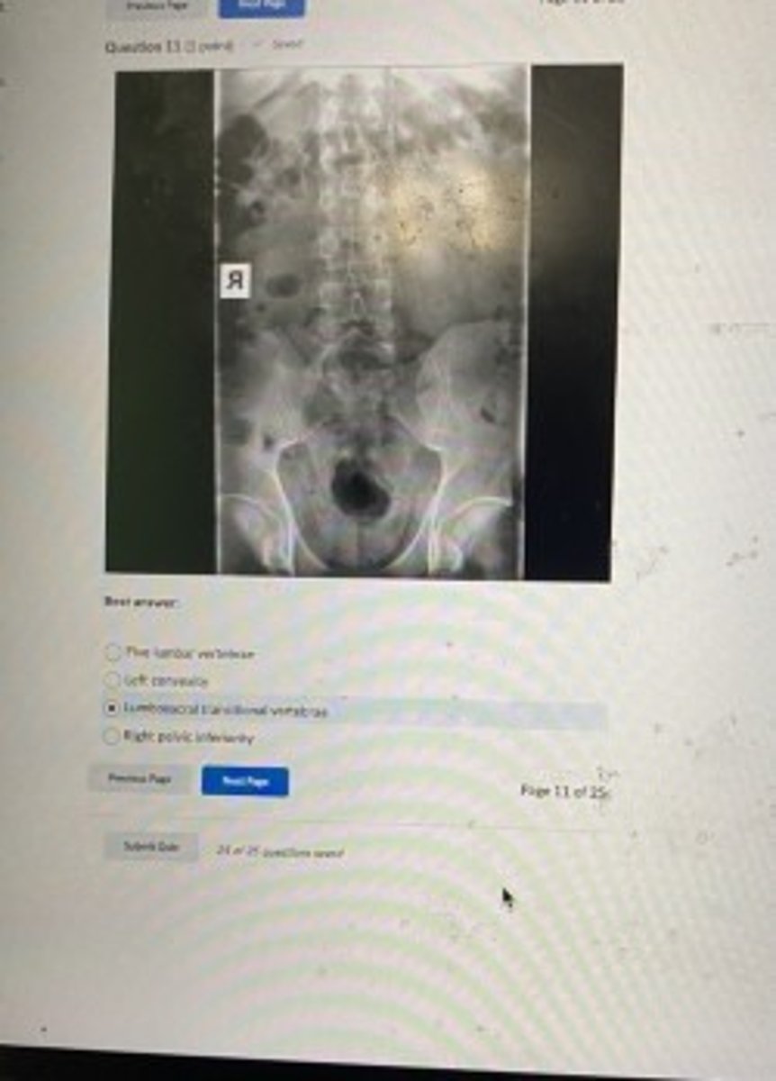 <p>Lumbosacral transitional vertebrae</p>