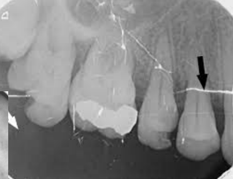 <p>Torn/Scratched Film</p>