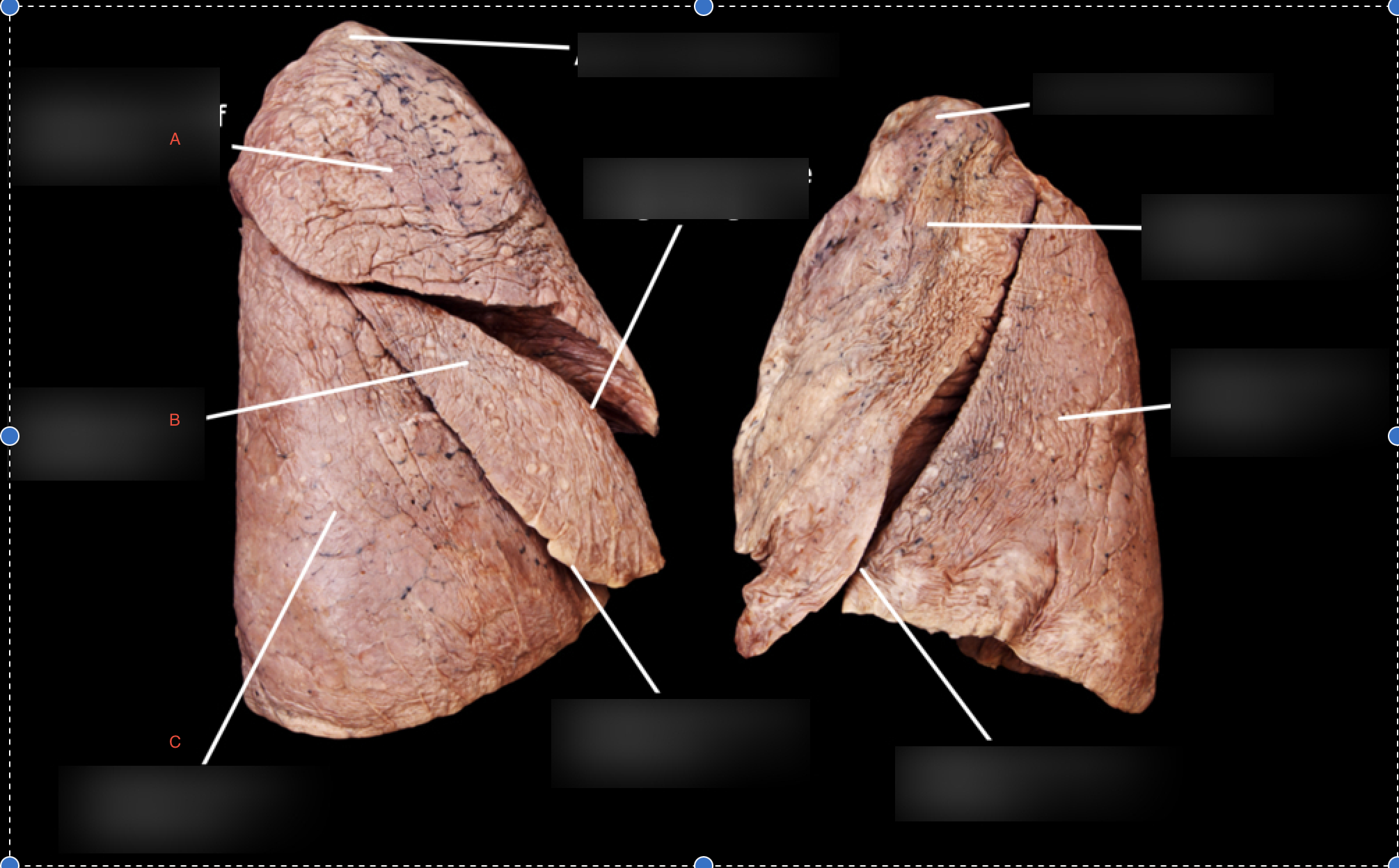 <p>What lobe of lung is A?</p>