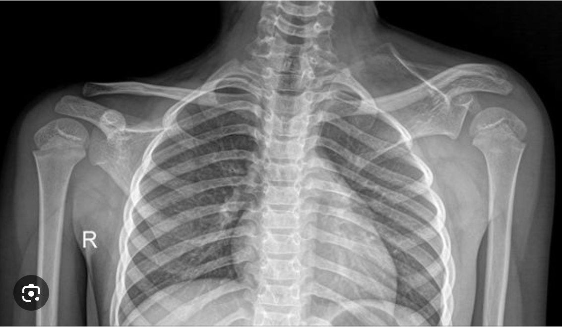 <p>One shoulder blade sits abnormally high on back </p>