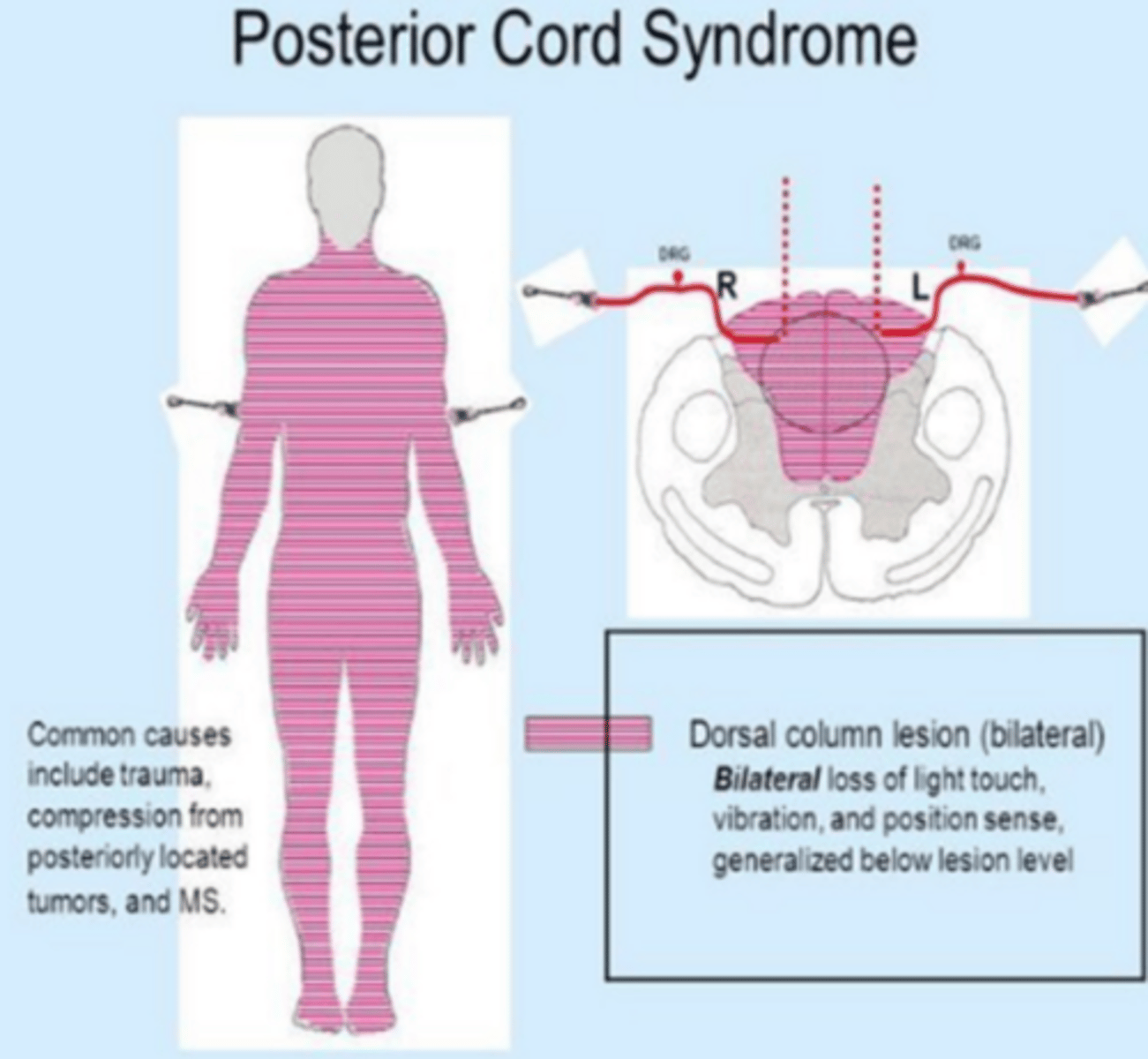 <p>causes: RARE iatrogenic aka medical error; compression of posterior spinal artery or (NPTE focuses on medical error) hyperextension injury</p><p>-DCML affected ... loss of vibration, proprioception, 2 point discrimination, sterognosis</p><p>-motor function is preserved </p><p>-sensory ataxia due to DCML involvement</p>