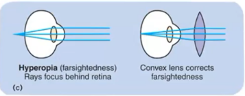<p>The image focuses behind the retina because the eyeball is too short. Far objects are clear and close ones are blurry. It's corrected with a convex lens.</p>