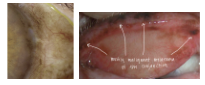 <p>What is the most likely diagnosis ?</p>