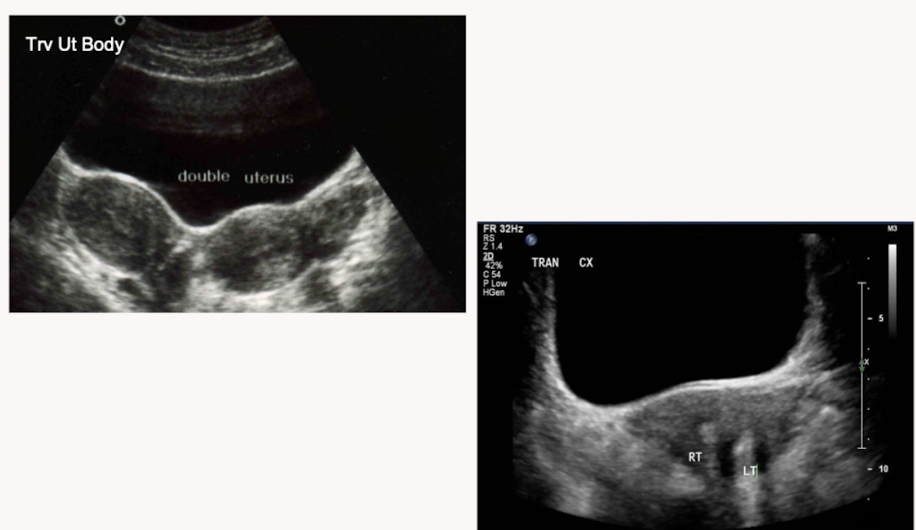 <p>Name the uterine anomaly </p>