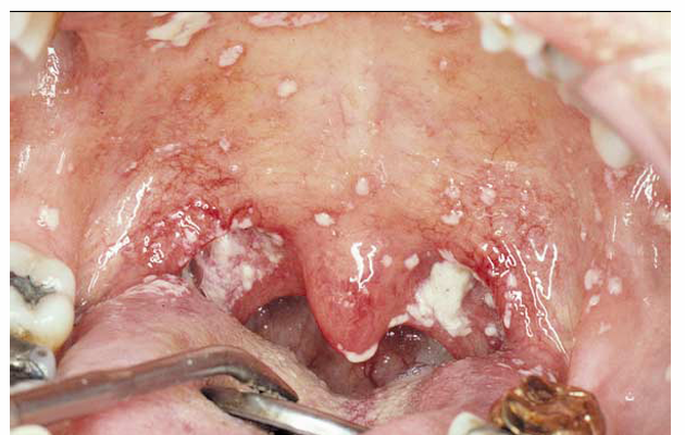 <p>1.what is this lesion?</p><p>2. how to treat/ manage it?</p><p>3. classification of oral lesion in HIV?</p>