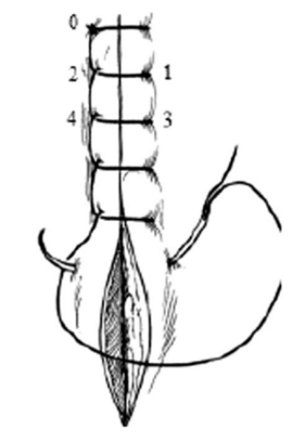 <ul><li><p>continuous pattern where each loop is locked by the succeeding pass</p></li><li><p><strong>appositional</strong></p></li><li><p>advantages / disadvantages</p><ul><li><p>precise adaptation</p></li><li><p>greater security in the event of a partial failure</p></li><li><p>may be difficult to remove</p></li><li><p>may cause pressure necrosis & become buried when placed under tension</p></li></ul></li></ul><p></p>