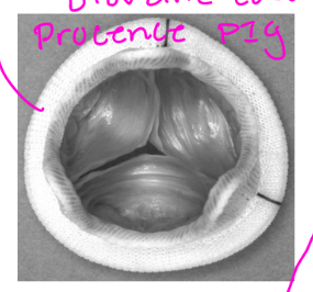 <p>• No anticoagulation</p>