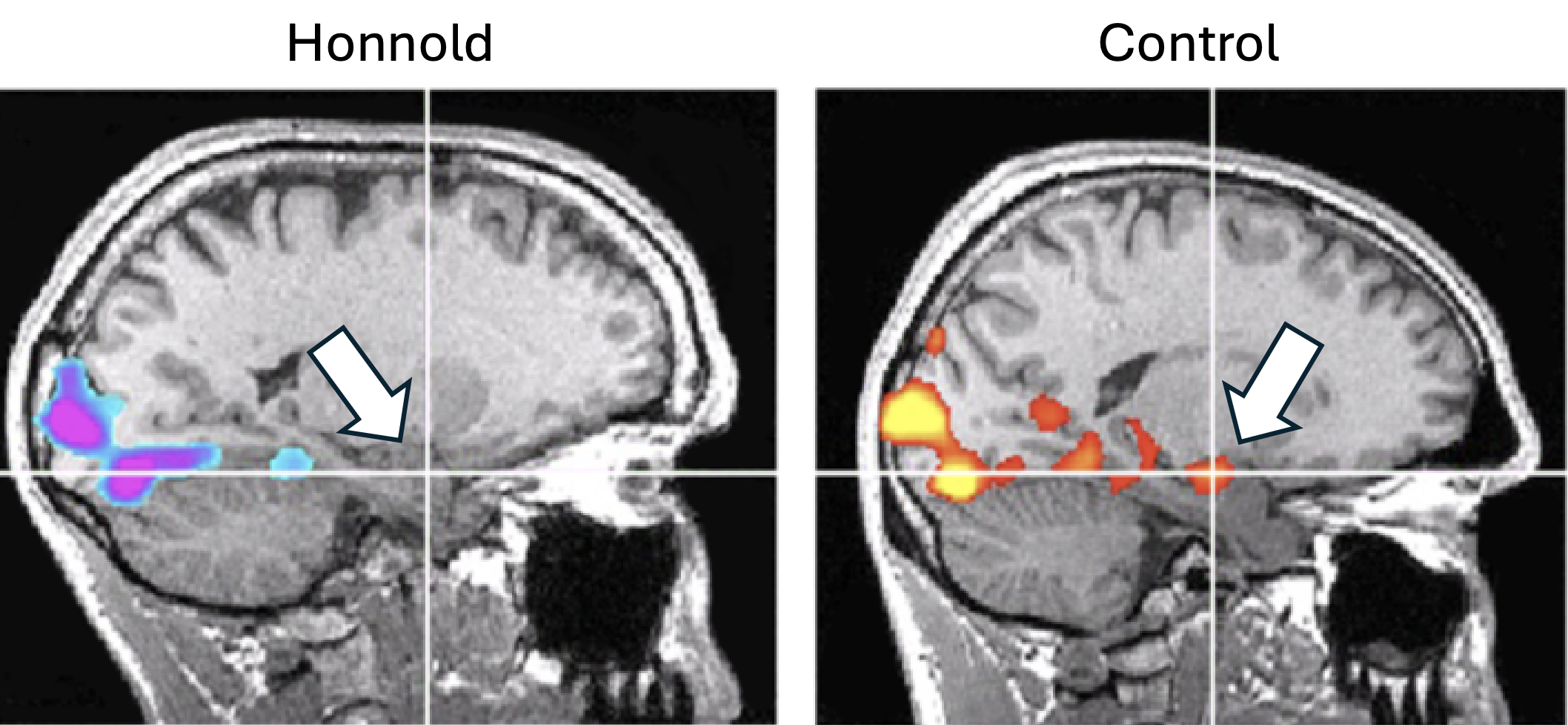 <p>Famous free solo rock climber</p><p>Showed little amygdala activity when presented with frightening or disturbing images</p>
